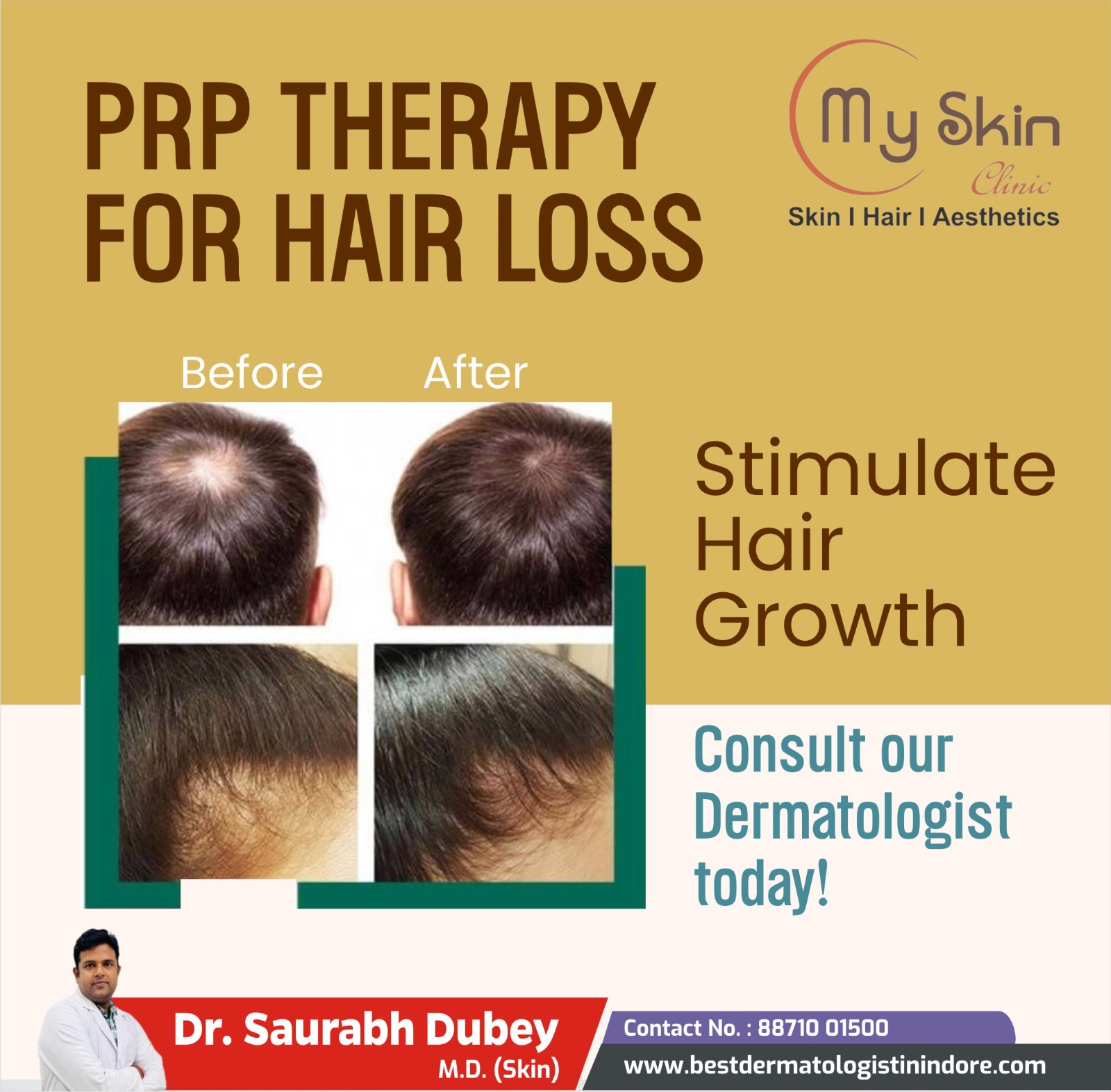 Best Hair Specialist for PRP Treatment in Indore